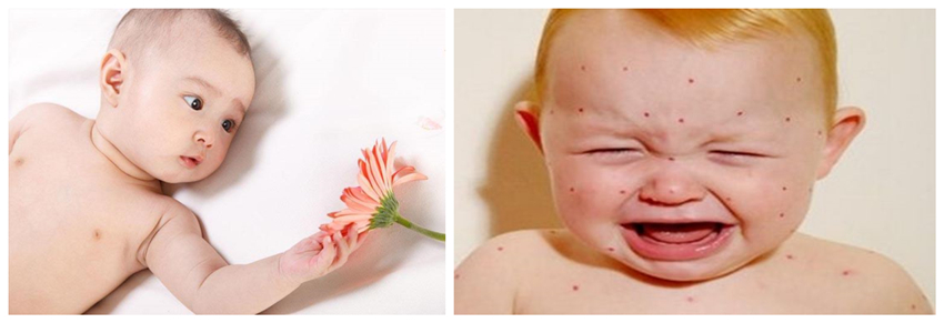 兒童濕疹反反復(fù)復(fù)，您有在家安裝家用除濕產(chǎn)品嗎？